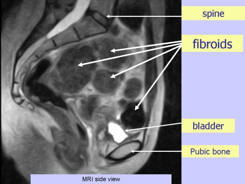 MRI Image of fibroids