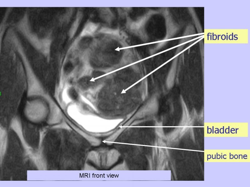 MRI Image of fibroids