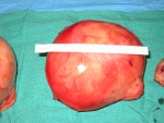 largest-fibroids-were-each-15-cm
