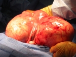 uterus-in-the-middle-of-two-large-fibroids