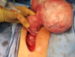 Uterus on the left and pedunculated fibroid on the right