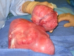 Large fibroid uterus with pedunculated fibroid in back